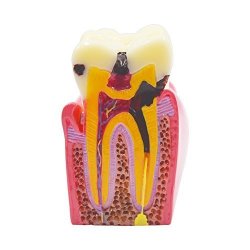 Dental Implants Supplies Dental Teeth Models 6TIMES Caries Comparation